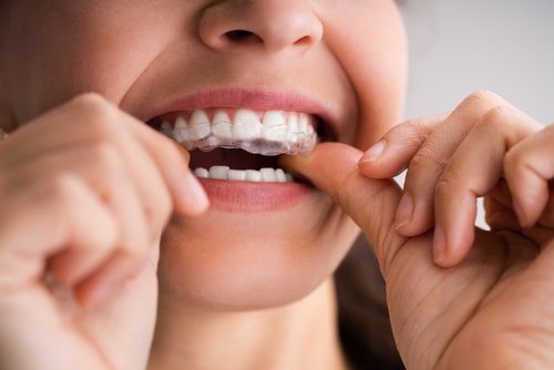 Clear Aligners in Colorado Springs, CO Invisible Braces
