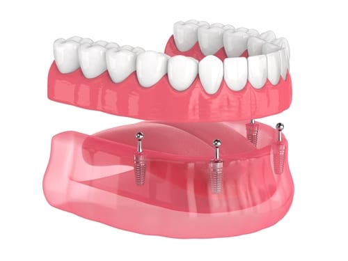 Mini Dental Implants in Colorado Springs, CO Mini Implant Dentist