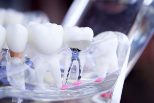 Root Canal Therapy in Colorado Springs, CO Best Care Dental